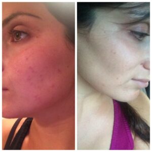 A woman with acne and a before and after picture.