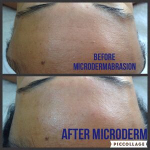A before and after picture of microdermabrasion.