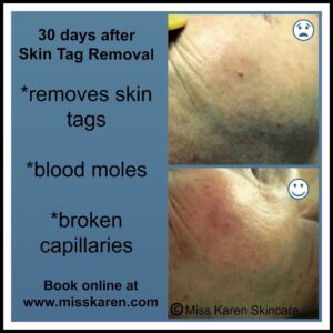 A picture of the skin tag removal process.