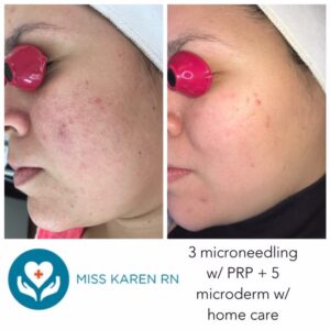 A woman with acne and microderm on her face.