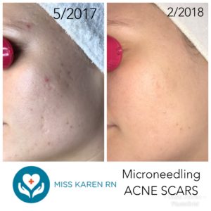 A before and after picture of a woman 's acne scars.